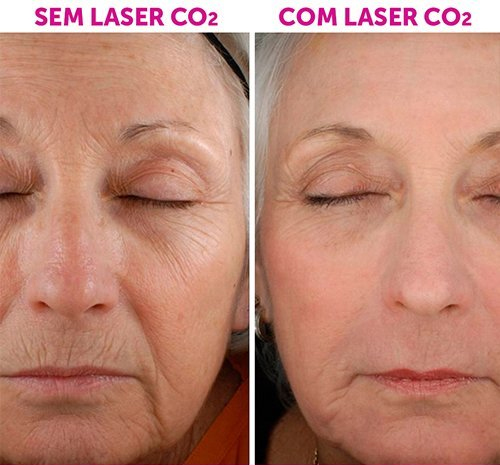 Antes e depois de tratamento com laser no rosto
